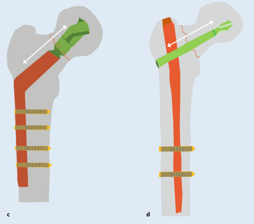 关于股骨颈骨折，你了解多少，这篇实用干货给你准备好了！