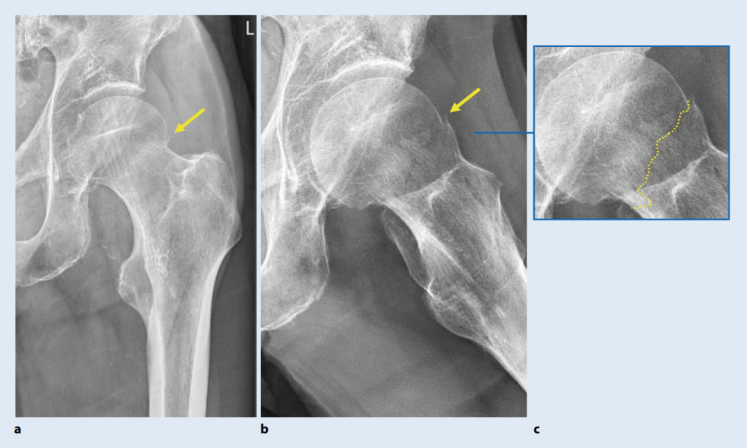 关于股骨颈骨折，你了解多少，这篇实用干货给你准备好了！