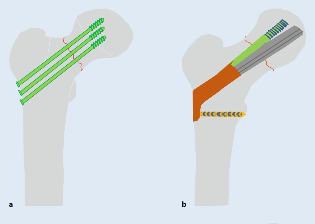 关于股骨颈骨折，你了解多少，这篇实用干货给你准备好了！
