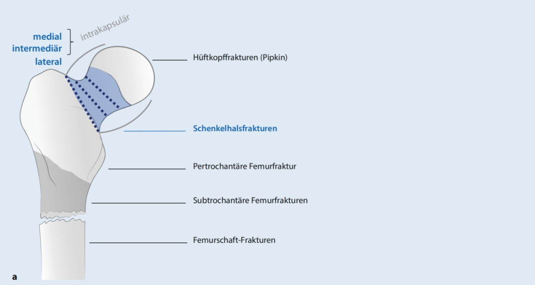 关于股骨颈骨折，你了解多少，这篇实用干货给你准备好了！