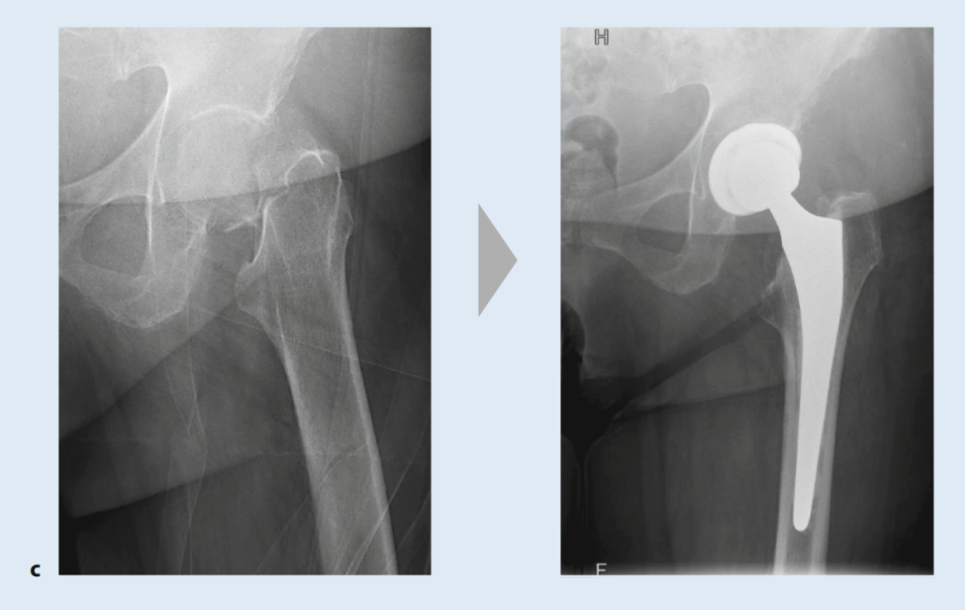 关于股骨颈骨折，你了解多少，这篇实用干货给你准备好了！