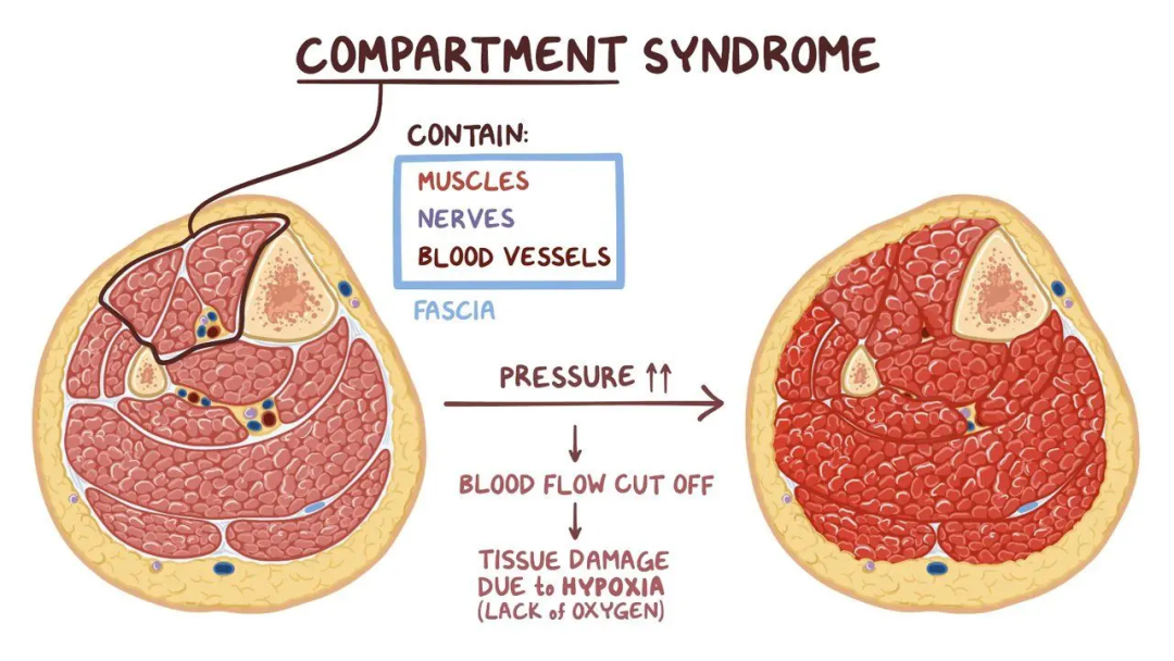 ​四室告急！因树木砸伤导致多部位骨筋膜室综合征，如何治疗？
