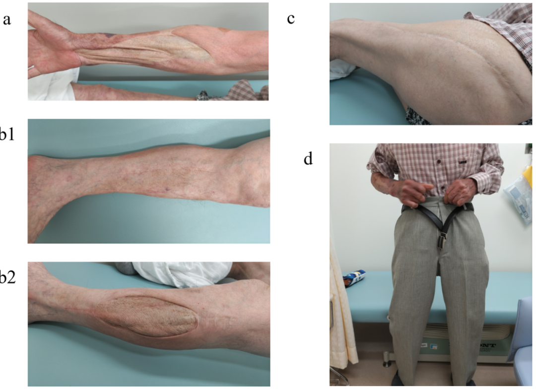 ​四室告急！因树木砸伤导致多部位骨筋膜室综合征，如何治疗？