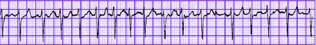 心律解码丨急诊心律失常的诊断及处理
