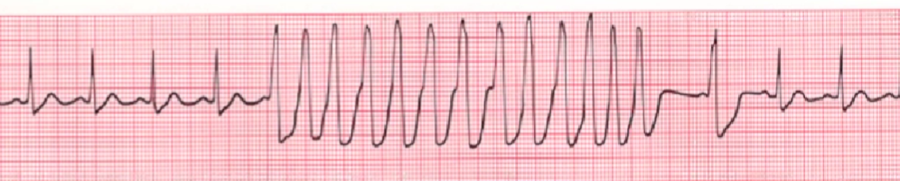 心律解码丨急诊心律失常的诊断及处理