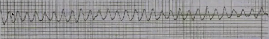 心律解码丨急诊心律失常的诊断及处理