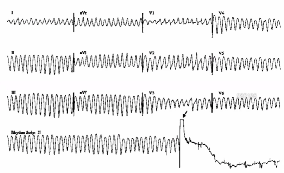 心律解码丨急诊心律失常的诊断及处理
