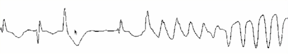 心律解码丨急诊心律失常的诊断及处理