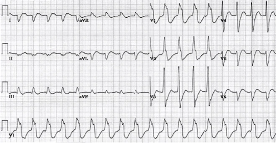 心律解码丨急诊心律失常的诊断及处理