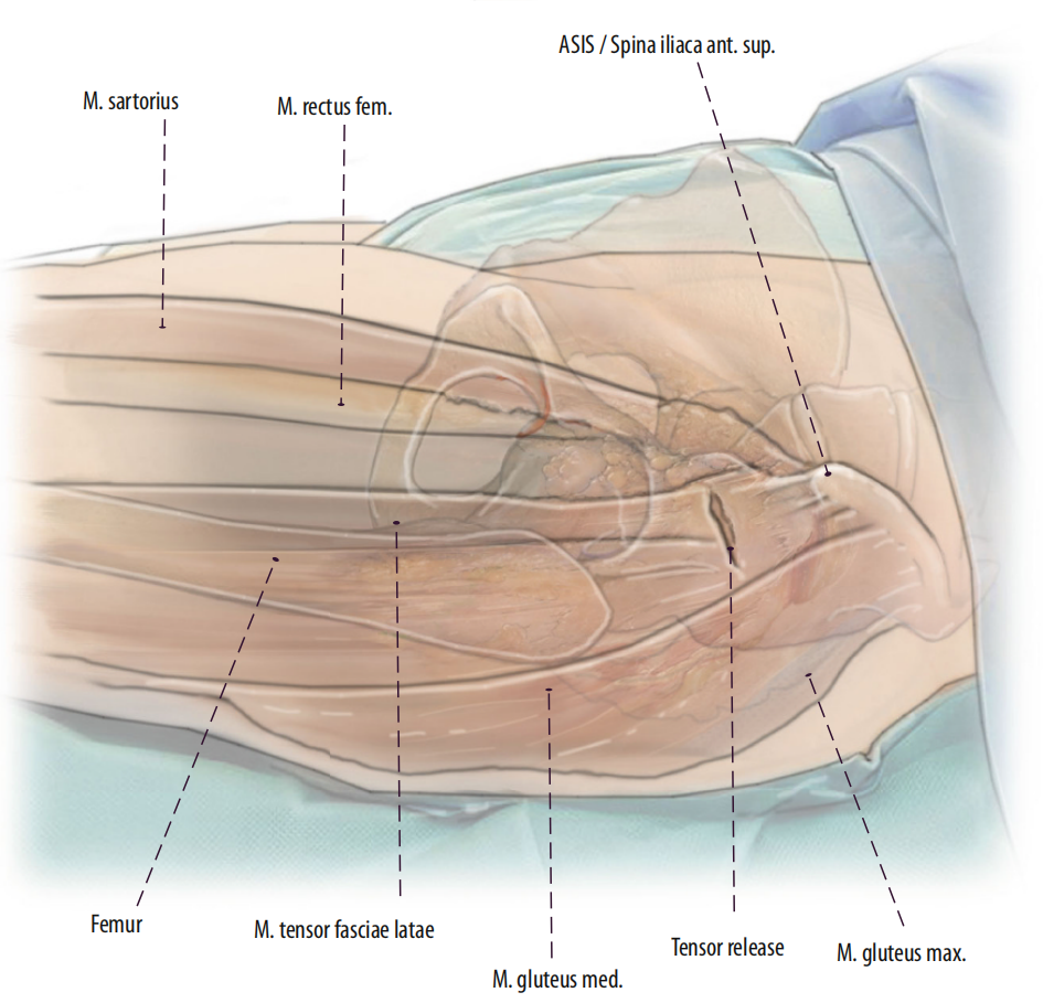 图文并茂：股骨翻修手术中的直接前入路（DAA）技术详解