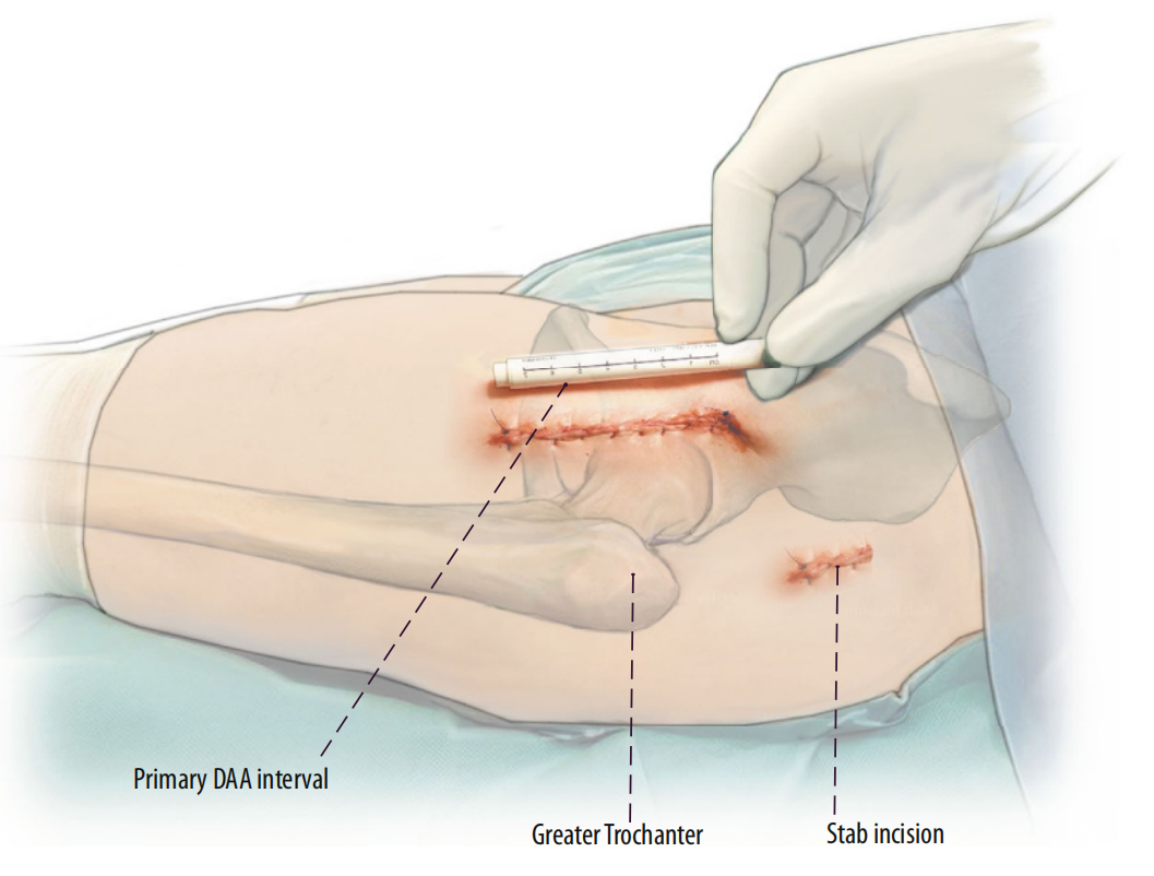 图文并茂：股骨翻修手术中的直接前入路（DAA）技术详解