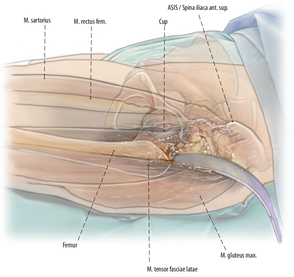 图文并茂：股骨翻修手术中的直接前入路（DAA）技术详解