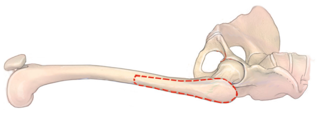 图文并茂：股骨翻修手术中的直接前入路（DAA）技术详解
