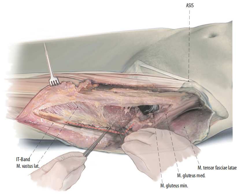 图文并茂：股骨翻修手术中的直接前入路（DAA）技术详解