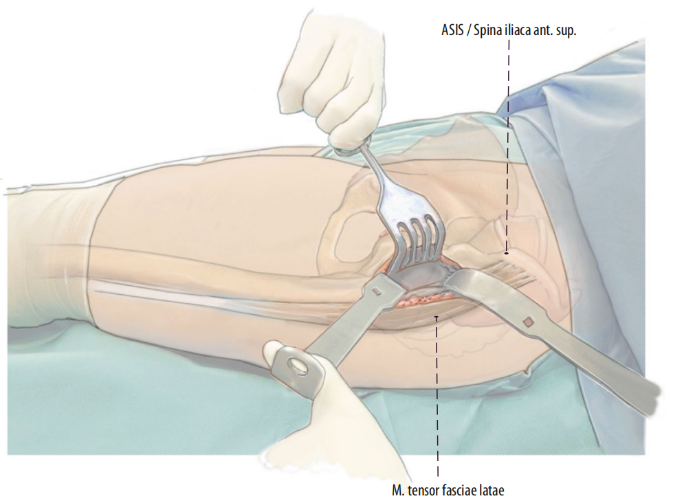 图文并茂：股骨翻修手术中的直接前入路（DAA）技术详解