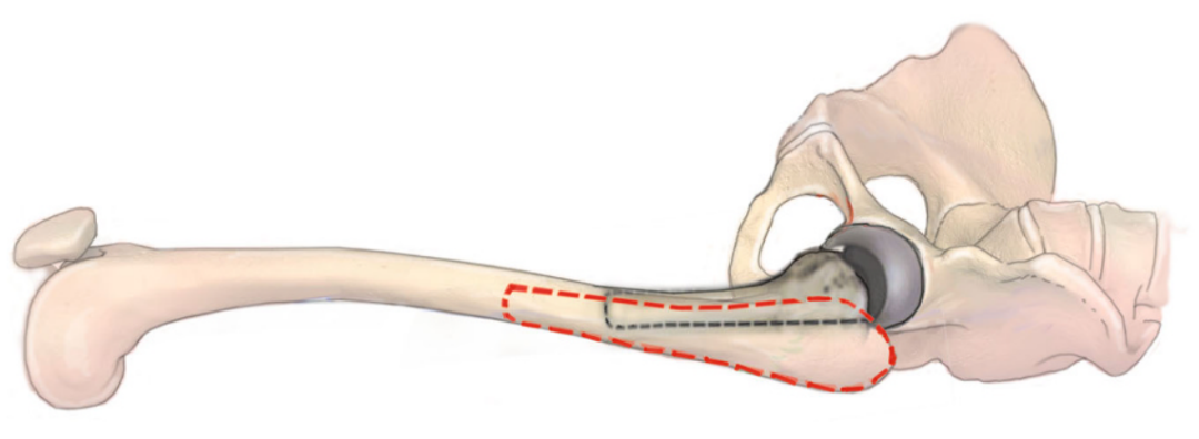 图文并茂：股骨翻修手术中的直接前入路（DAA）技术详解