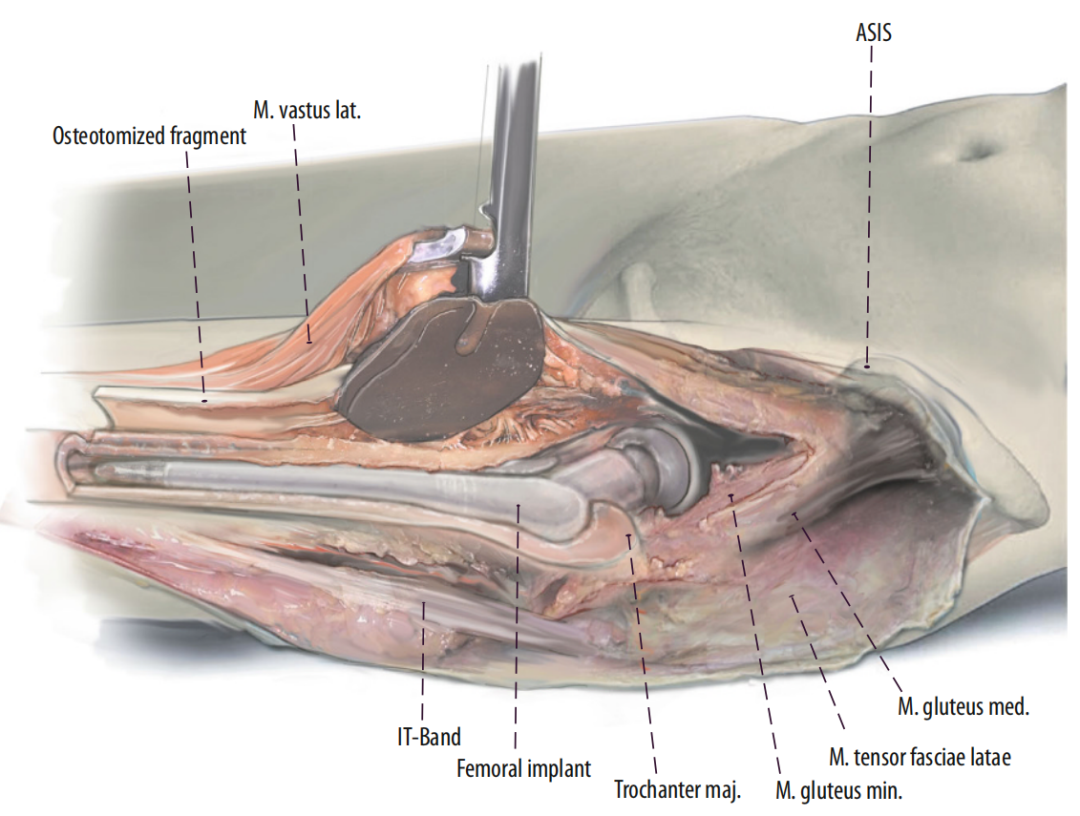 图文并茂：股骨翻修手术中的直接前入路（DAA）技术详解