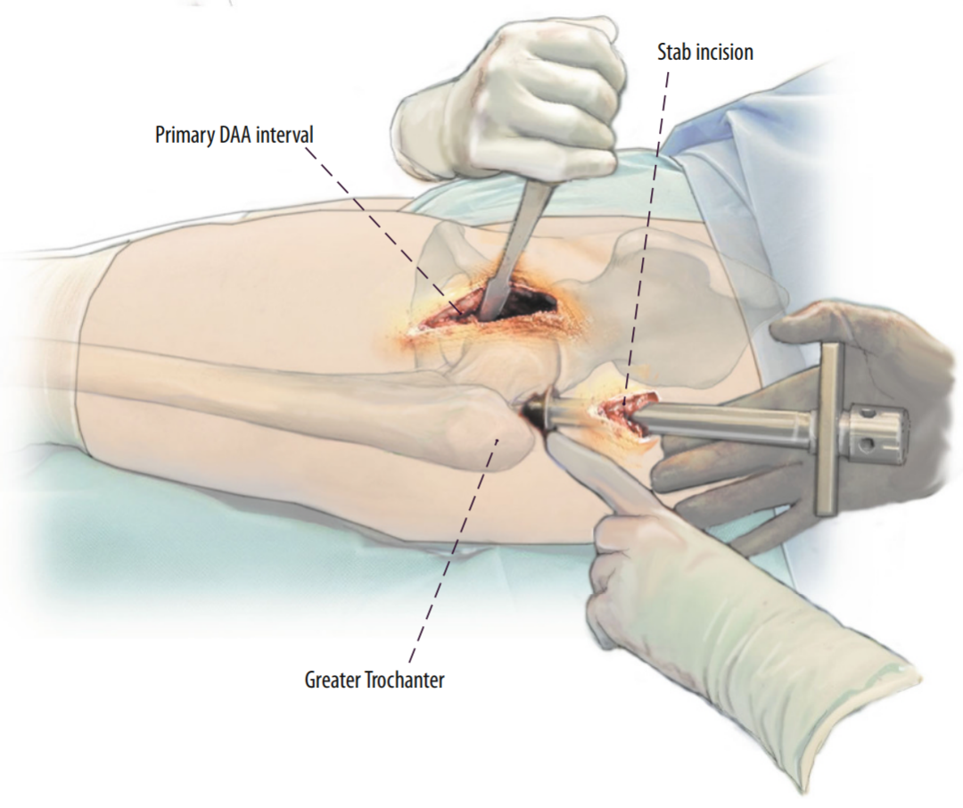 图文并茂：股骨翻修手术中的直接前入路（DAA）技术详解