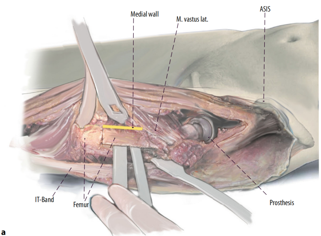 图文并茂：股骨翻修手术中的直接前入路（DAA）技术详解