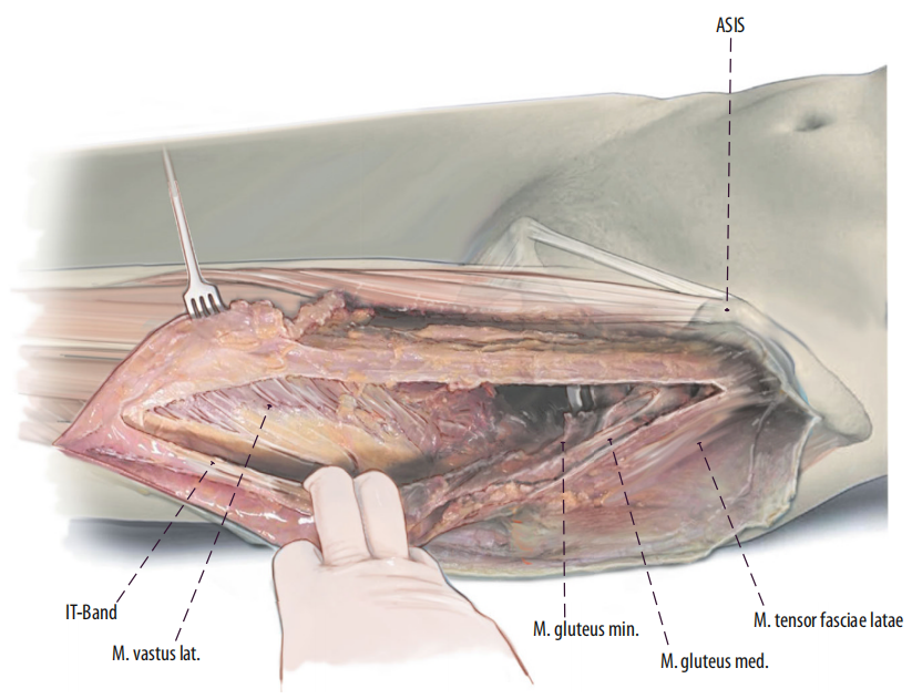 图文并茂：股骨翻修手术中的直接前入路（DAA）技术详解