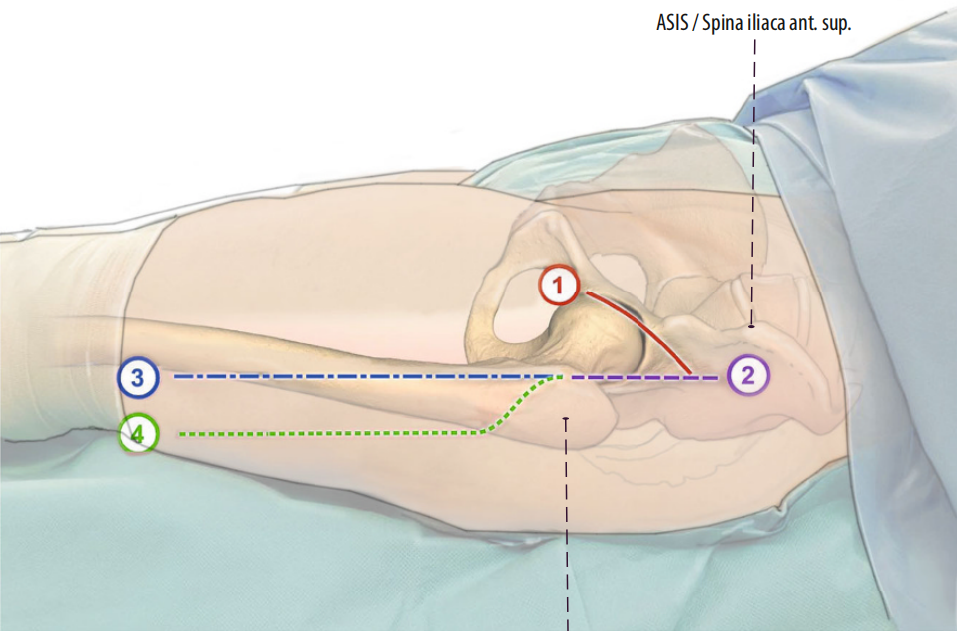 图文并茂：股骨翻修手术中的直接前入路（DAA）技术详解