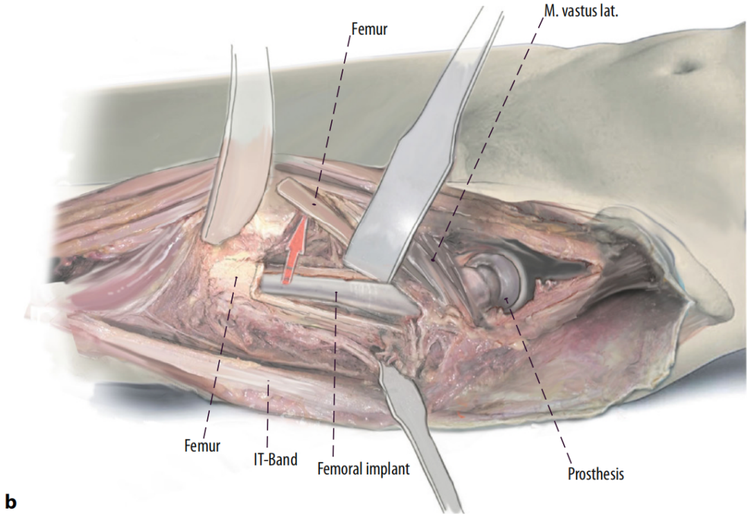 图文并茂：股骨翻修手术中的直接前入路（DAA）技术详解