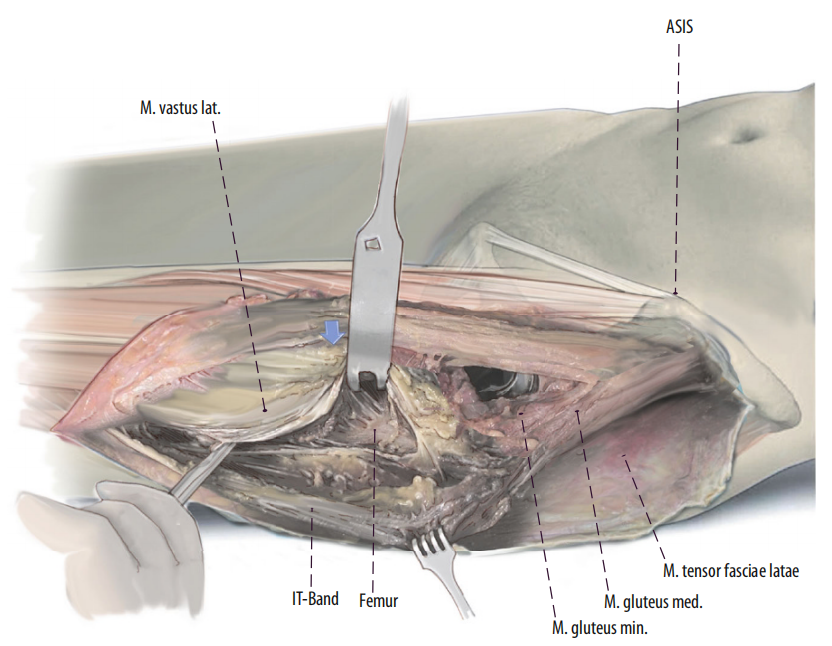 图文并茂：股骨翻修手术中的直接前入路（DAA）技术详解