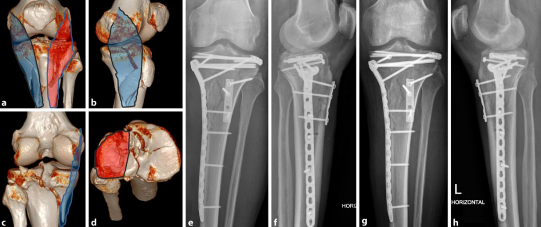 胫骨平台骨折的分型、治疗与入路选择