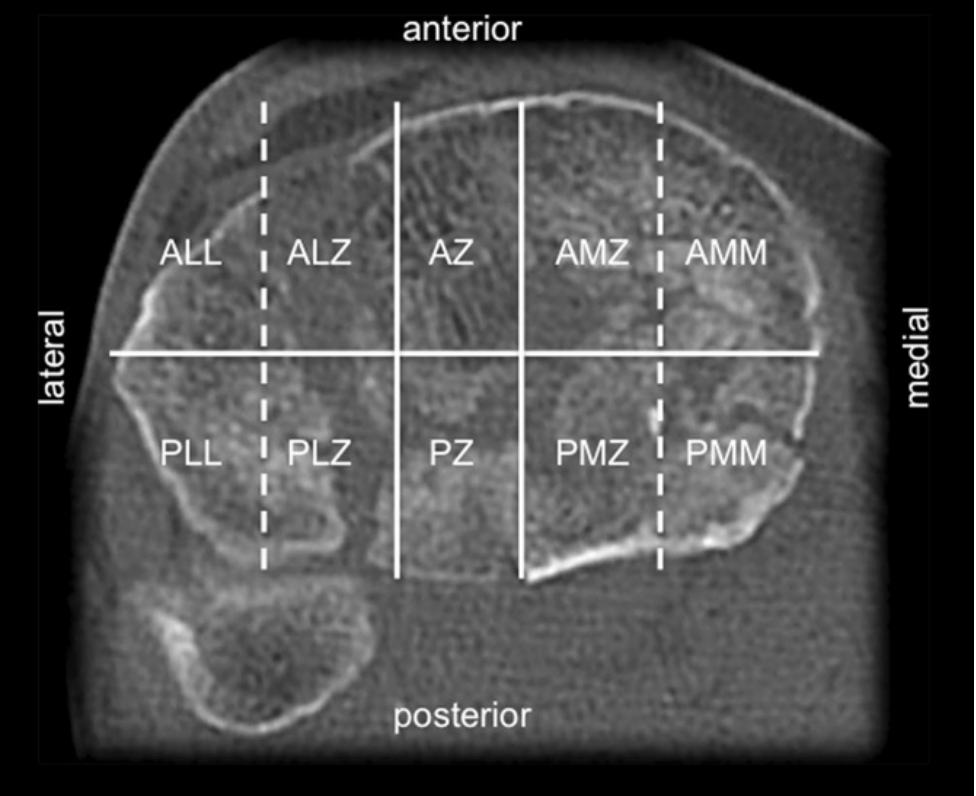 胫骨平台骨折的分型、治疗与入路选择