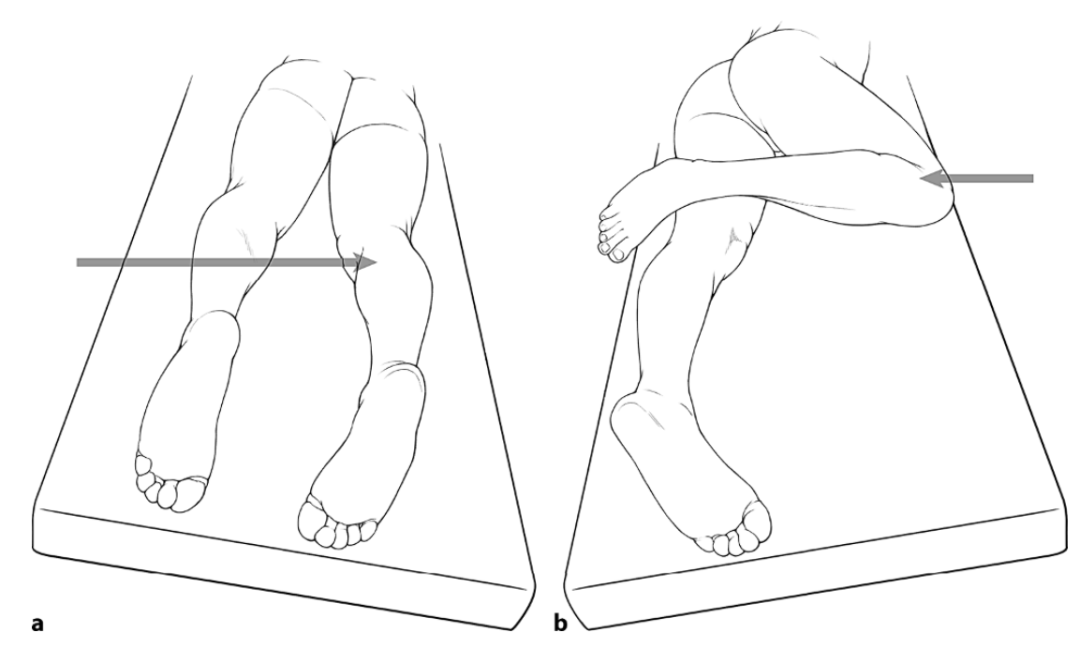 胫骨平台骨折的分型、治疗与入路选择