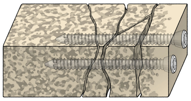 胫骨平台骨折的分型、治疗与入路选择