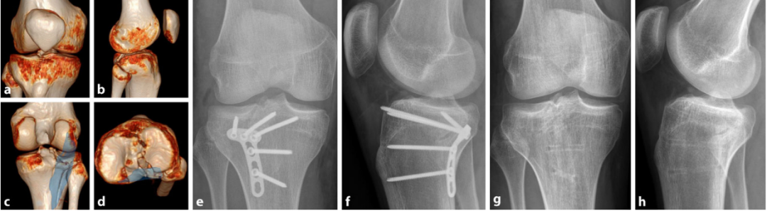 胫骨平台骨折的分型、治疗与入路选择