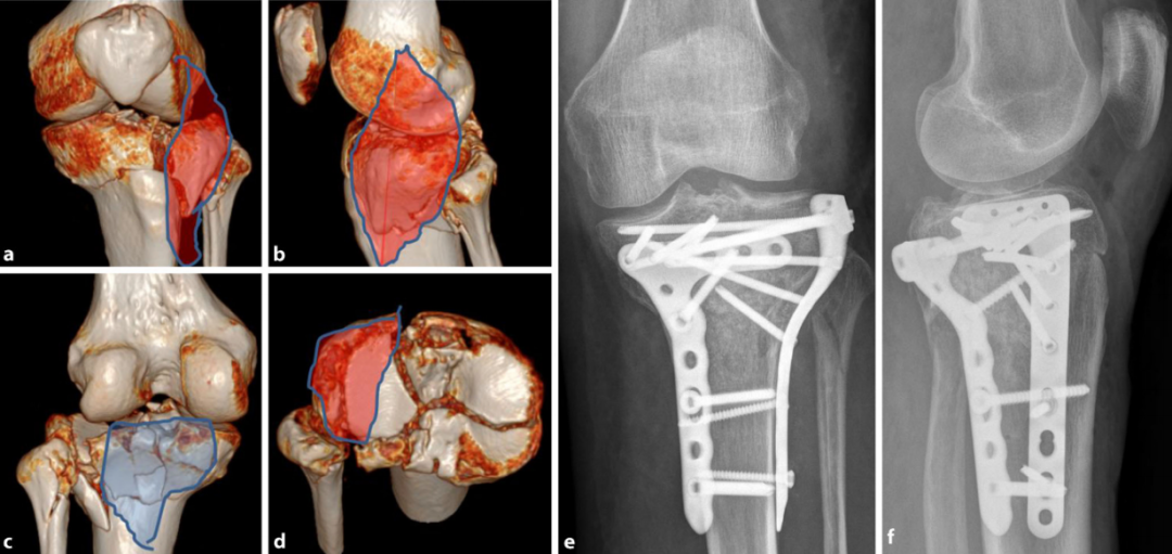 胫骨平台骨折的分型、治疗与入路选择