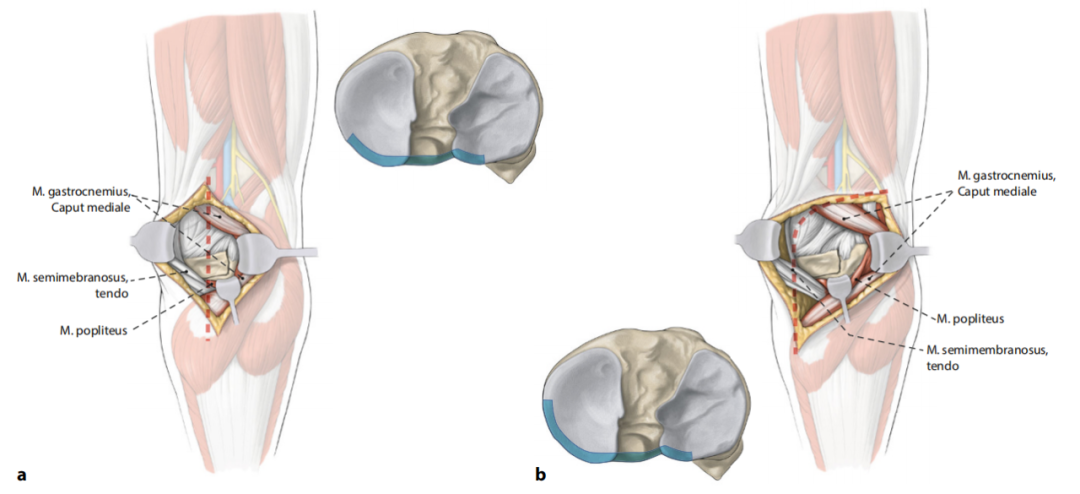胫骨平台骨折的分型、治疗与入路选择