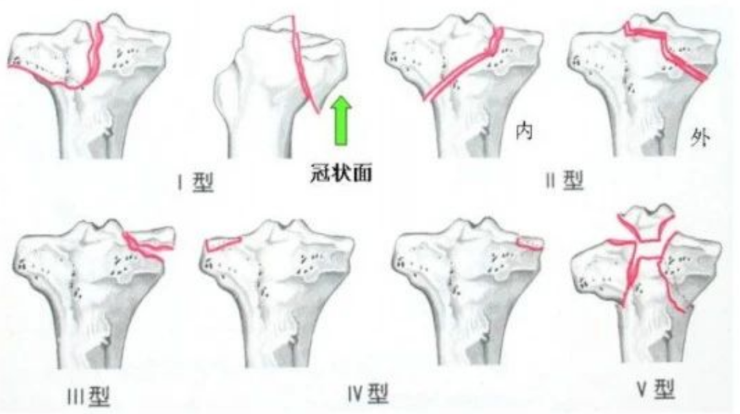 胫骨平台骨折的分型、治疗与入路选择