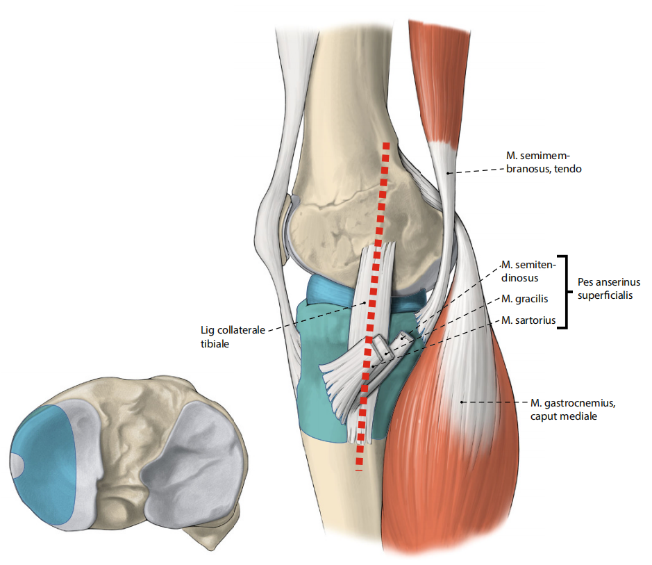 胫骨平台骨折的分型、治疗与入路选择