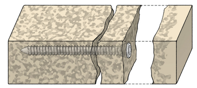 胫骨平台骨折的分型、治疗与入路选择