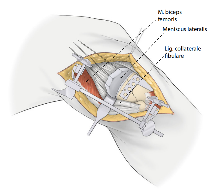 胫骨平台骨折的分型、治疗与入路选择
