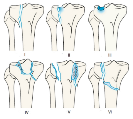 胫骨平台骨折的分型、治疗与入路选择