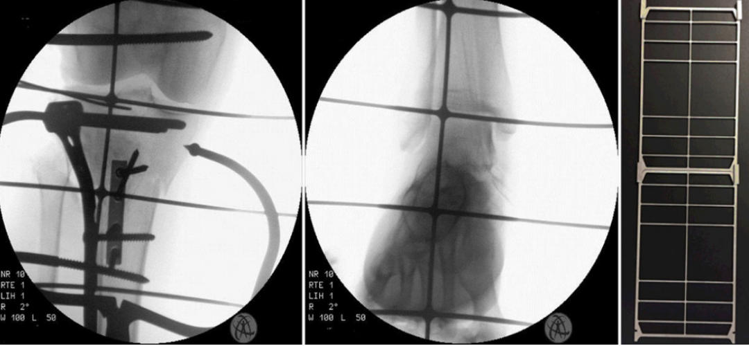 胫骨平台骨折的分型、治疗与入路选择