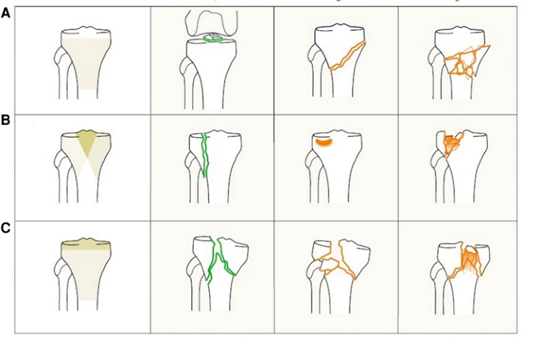 胫骨平台骨折的分型、治疗与入路选择