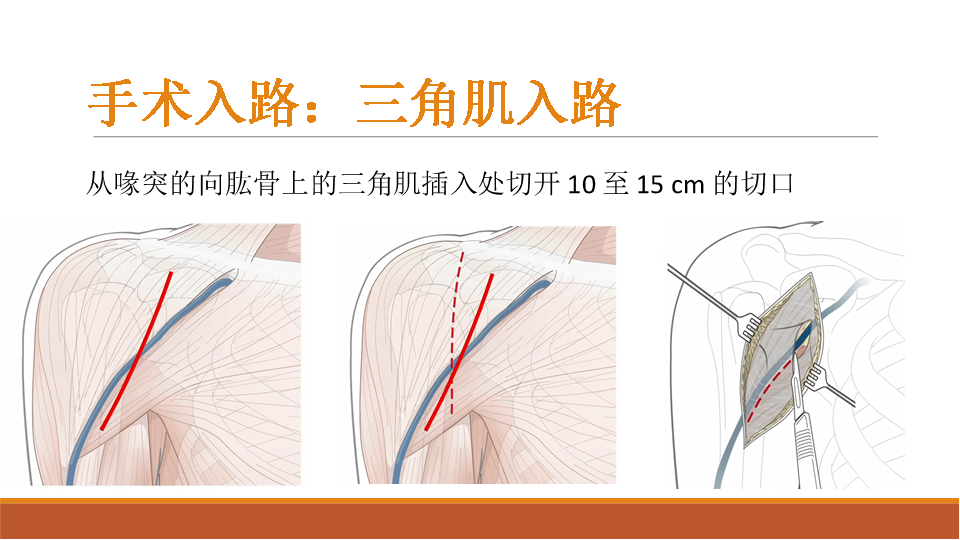 【收藏干货】肩关节置换术的教育手册