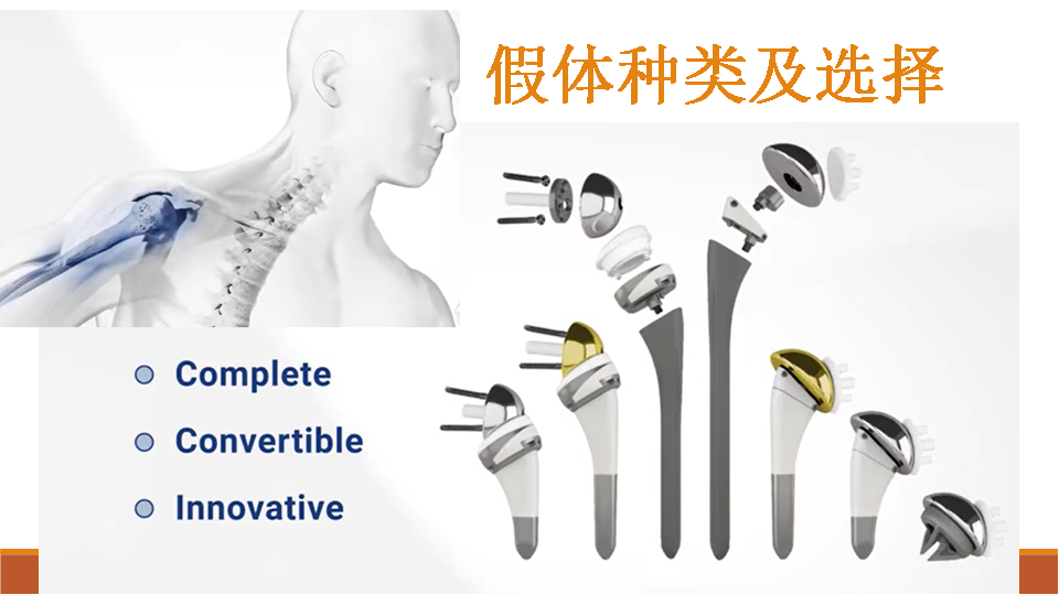 【收藏干货】肩关节置换术的教育手册