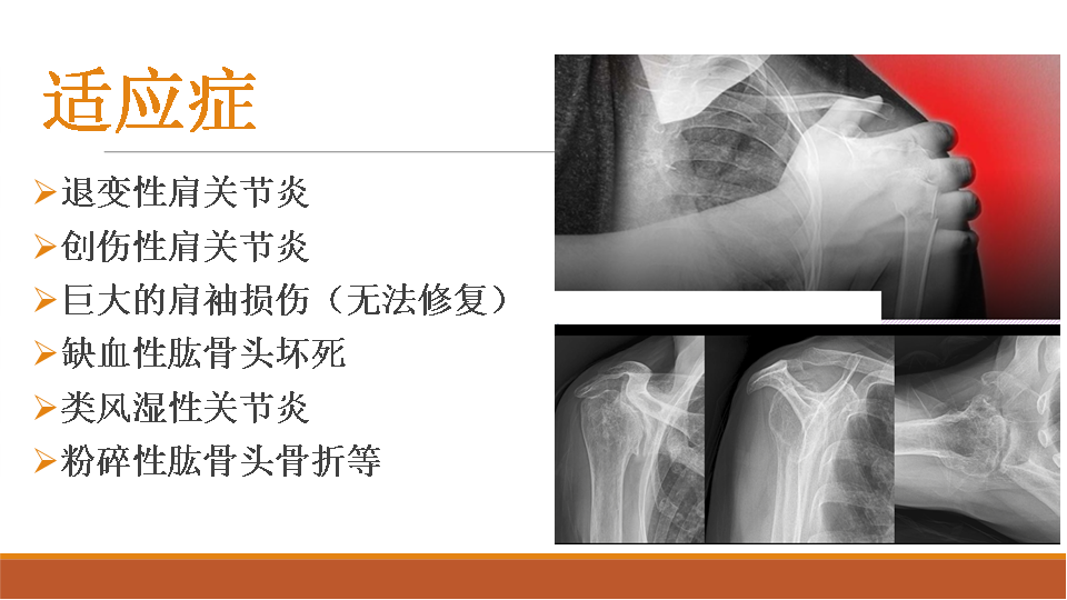 【收藏干货】肩关节置换术的教育手册