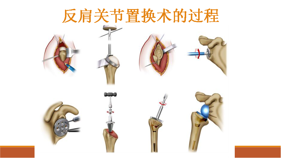 【收藏干货】肩关节置换术的教育手册