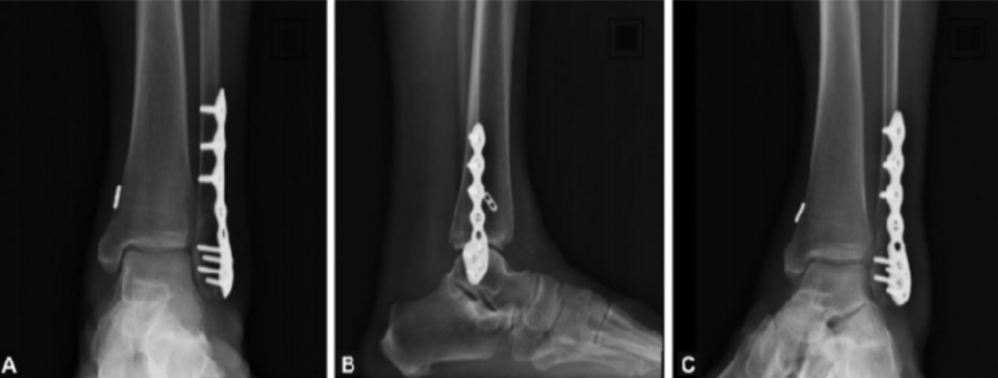 踝关节下胫腓联合损伤的诊治