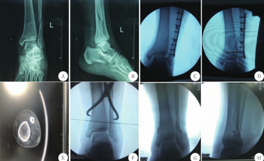 踝关节下胫腓联合损伤的诊治