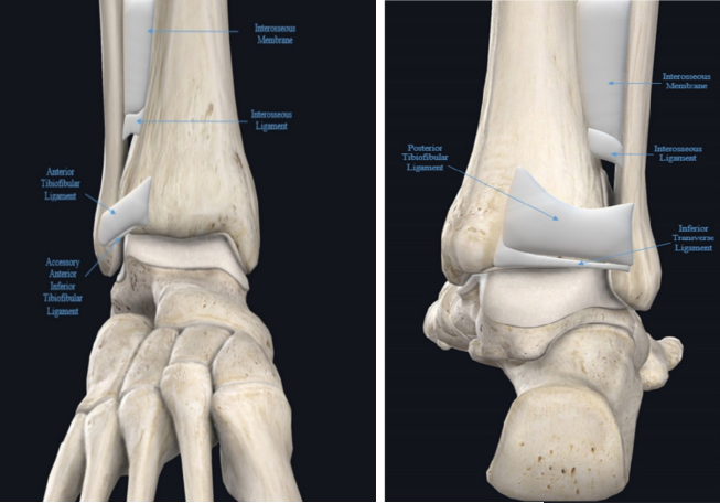 踝关节下胫腓联合损伤的诊治