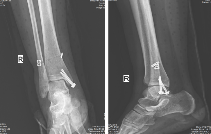 踝关节下胫腓联合损伤的诊治