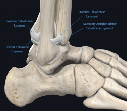 踝关节下胫腓联合损伤的诊治